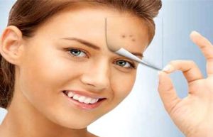ژل موضعی آداپالن