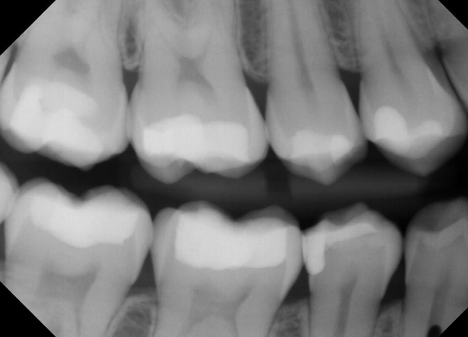درد دندان بعد از پر کردن