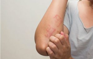 پماد تاکرولیموس