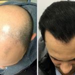 کاشت مو به روش FIT