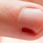 علت ریشه شدن کنار ناخن