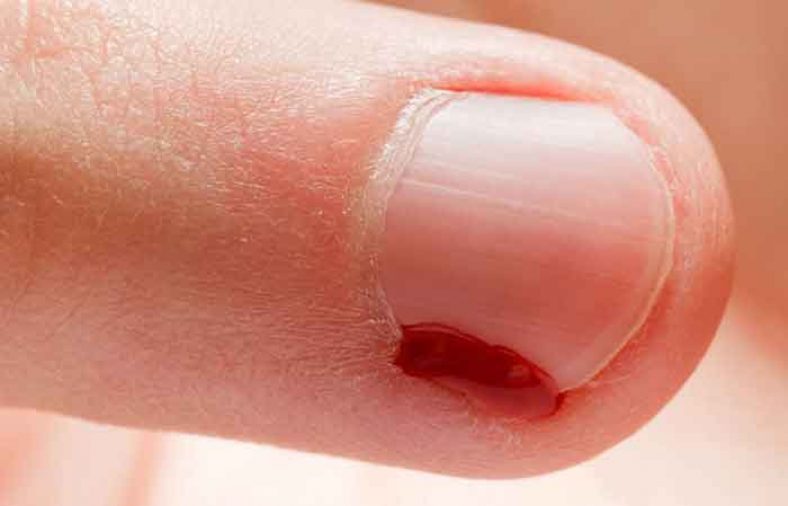 علت ریشه شدن کنار ناخن