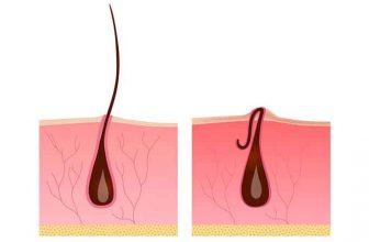 درمان موهای زیر پوستی ناحیه تناسلی