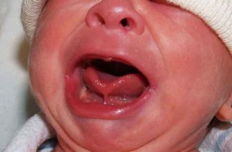 چسبندگی زبان به کف دهان نوزاد