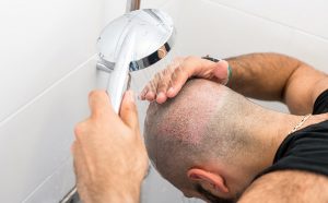 شستشوی سر بعد از کاشت مو
