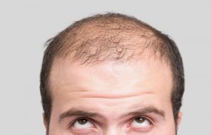 قرص برای رشد سریع موها