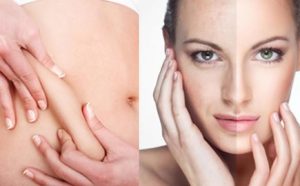 مزوتراپی برای لاغری موضعی