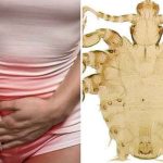 شپش ناحیه تناسلی