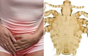 شپش ناحیه تناسلی
