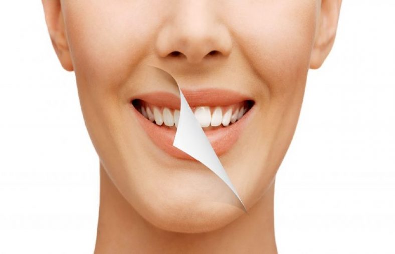 لاک سفید کننده دندان