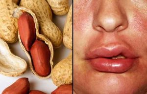 علائم حساسیت به بادام زمینی