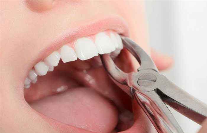 مراقبت‌ های بعد از کشیدن دندان؛ نکات ضروری و کابردی - ستاره