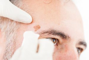 مراقبت های بعد از برداشتن خال