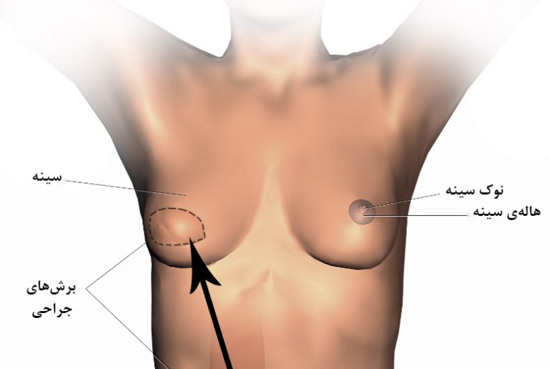 پروتز سینه پس از سرطان سینه