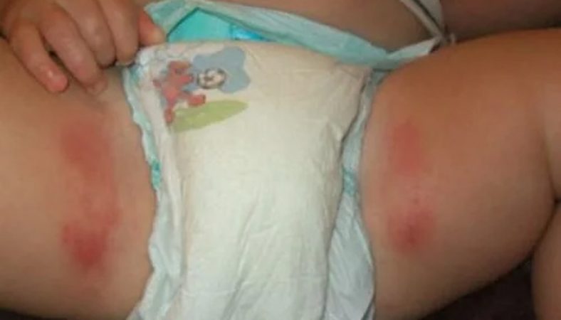 حساسیت نوزاد به پوشک