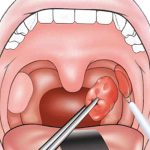 علائم عفونت لوزه