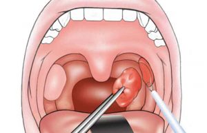 علائم عفونت لوزه
