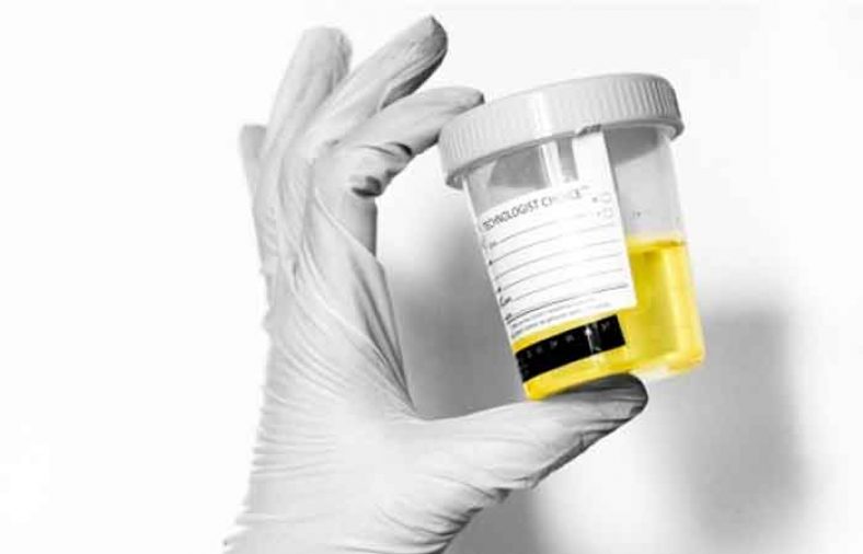 مخاط یا Mucus در آزمایش ادرار