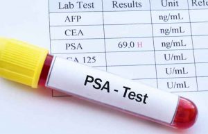 آزمایش پروستات (PSA)