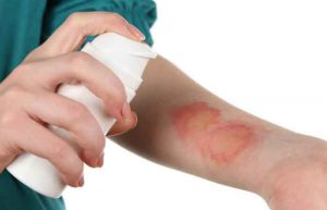 از بین بردن جای سوختگی روی پوست