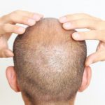 کاشت مو با بانک موی ضعیف