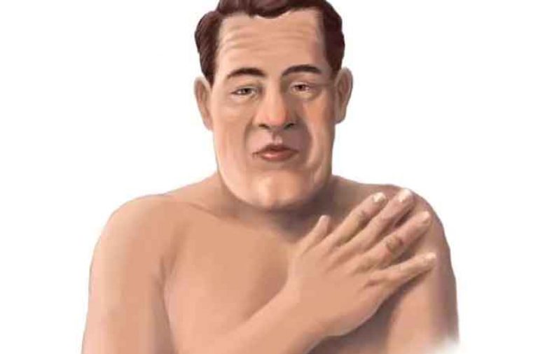 اکرومگالی