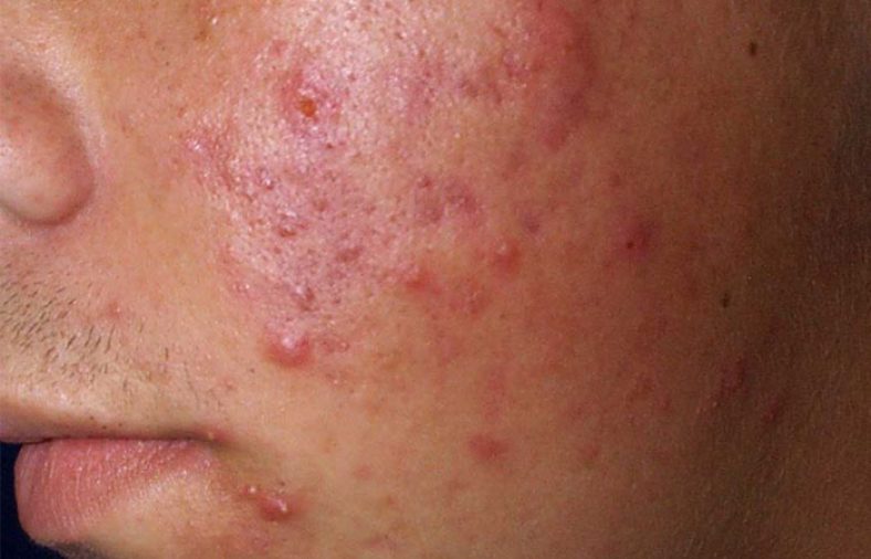 آیا پردنیزولون باعث ایجاد جوش صورت و بدن می‌شود؟