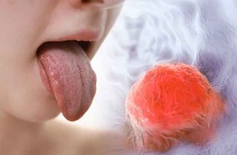 علائم سرطان زبان