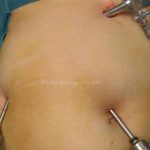 لاپاراسکوپی کیسه صفرا