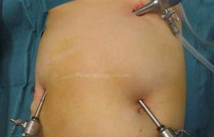 لاپاراسکوپی کیسه صفرا