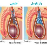 واریکوسل