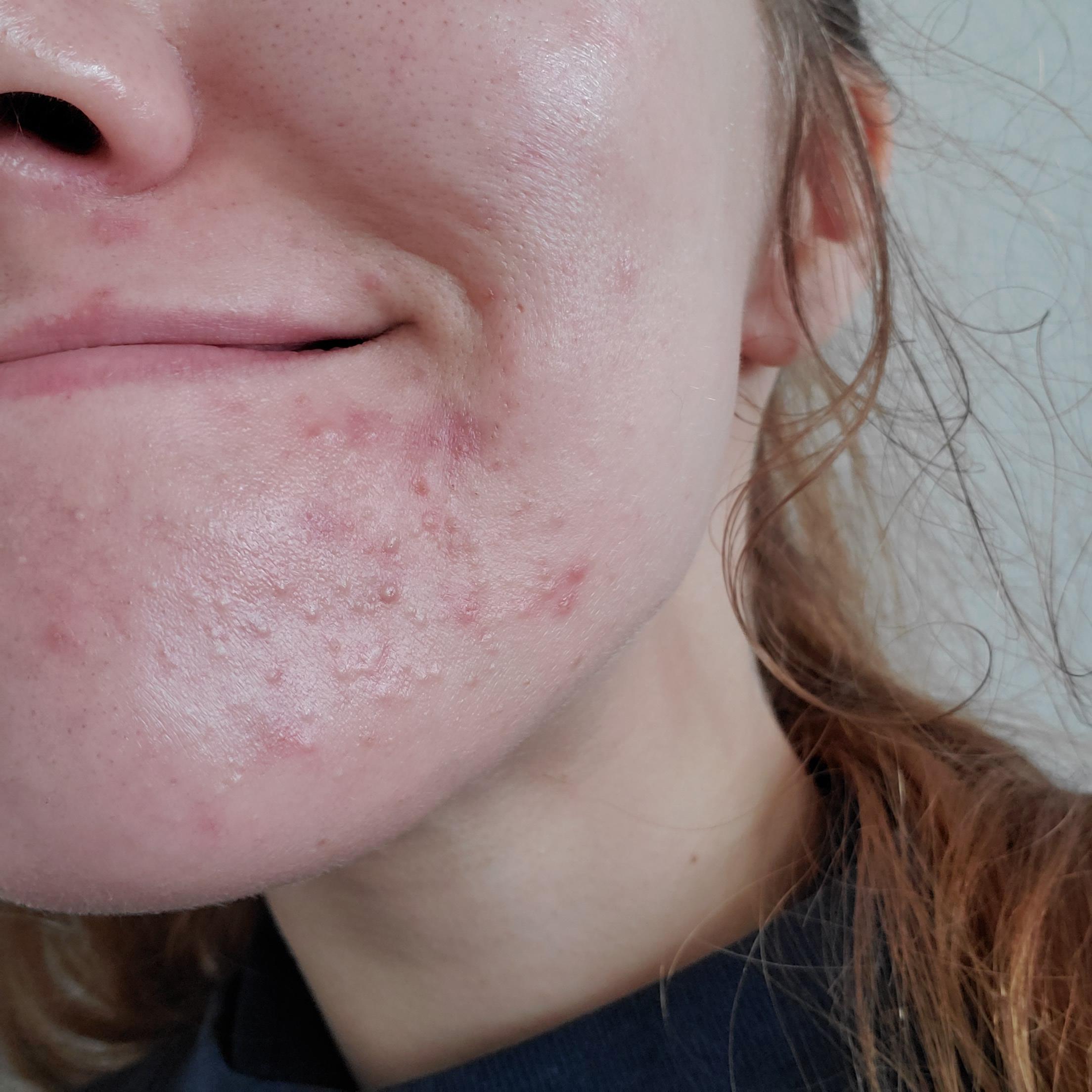 علت جوش های ریز صورت چیست