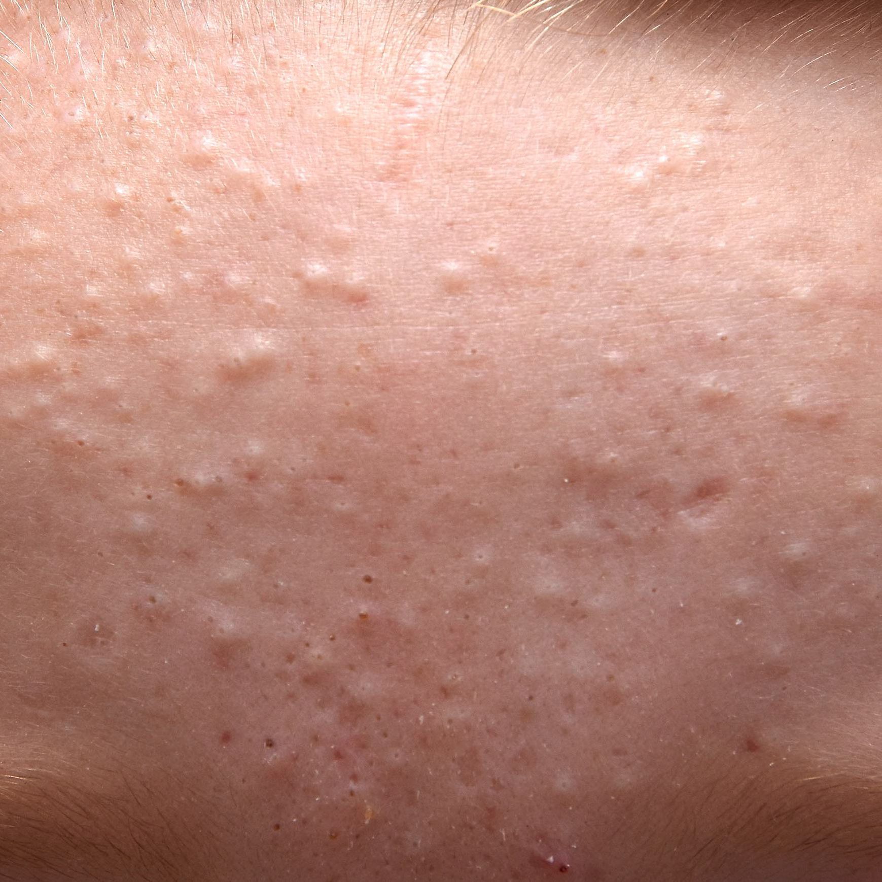 علت جوش های ریز صورت و گردن