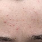 علت جوش های ریز صورت کودکان و بزرگسالان + درمان فوری