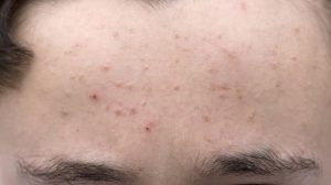 علت جوش های ریز صورت کودکان و بزرگسالان + درمان فوری