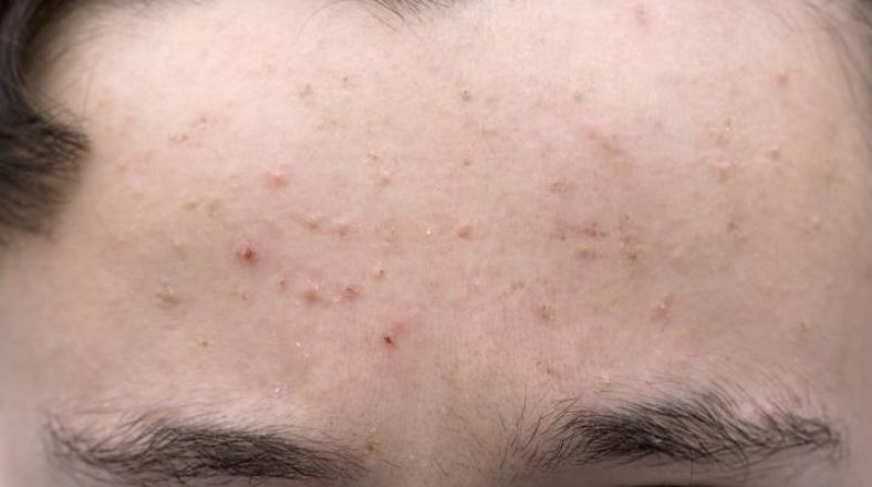علت جوش های ریز صورت کودکان و بزرگسالان + درمان فوری