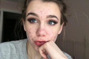 بهترین کرم برای جوش صورت ایرانی و خارجی کدام است؟