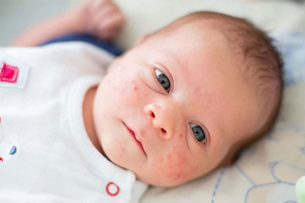 روش های تشخیص و درمان دانه‌ های قرمز روی پوست نوزاد