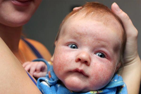 چه چیزی می‌تواند اگزما در نوزادان را بدتر کند؟