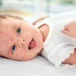 علائم حساسیت نوزاد به شیر خشک