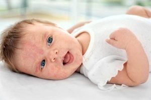 علائم حساسیت نوزاد به شیر خشک