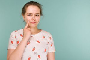 بهترین قرص برای جوش صورت