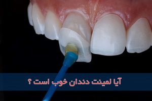 آیا لمینت دندان خوب است؟