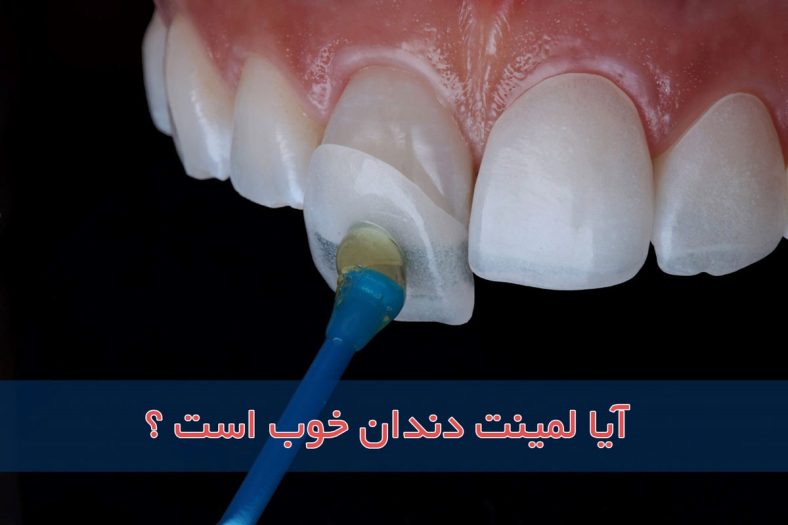 آیا لمینت دندان خوب است؟