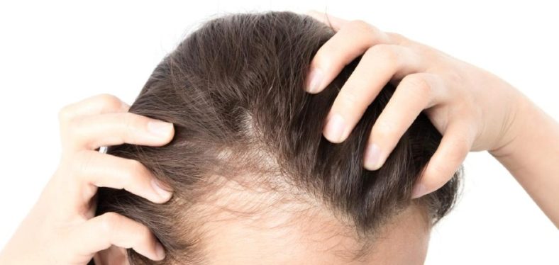 دلایل برای ریزش مو در خانم ها
