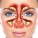 درمان سینوزیت