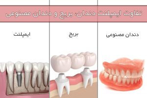 تفاوت ایمپلنت، بریج و دندان مصنوعی