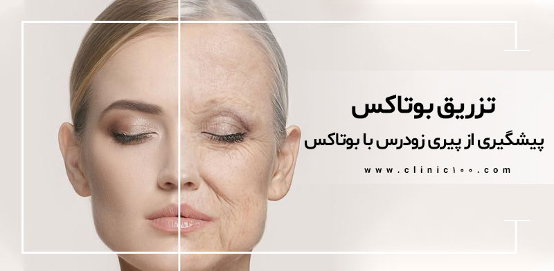 تزریق بوتاکس