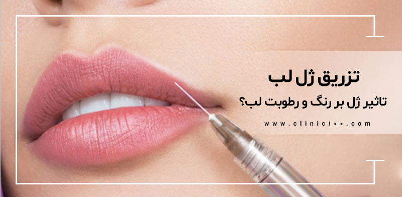 تزریق ژل لب