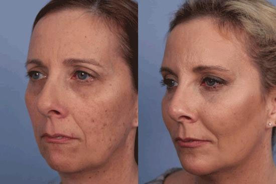 قبل و بعد از لیزر اربیوم برای جوانسازی پوست